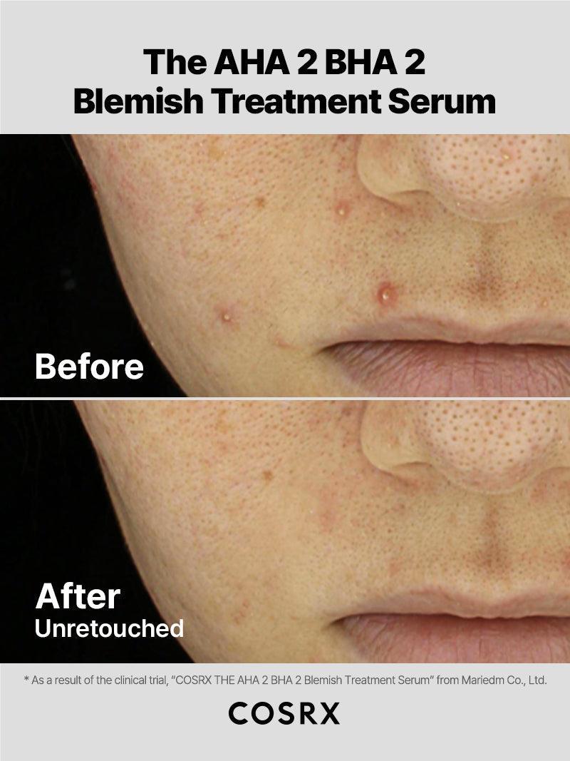 https://cdn.shopify.com/s/files/1/0513/3775/6828/files/AHA2BHA2_Blemish_03__2.jpg?v=1741592927