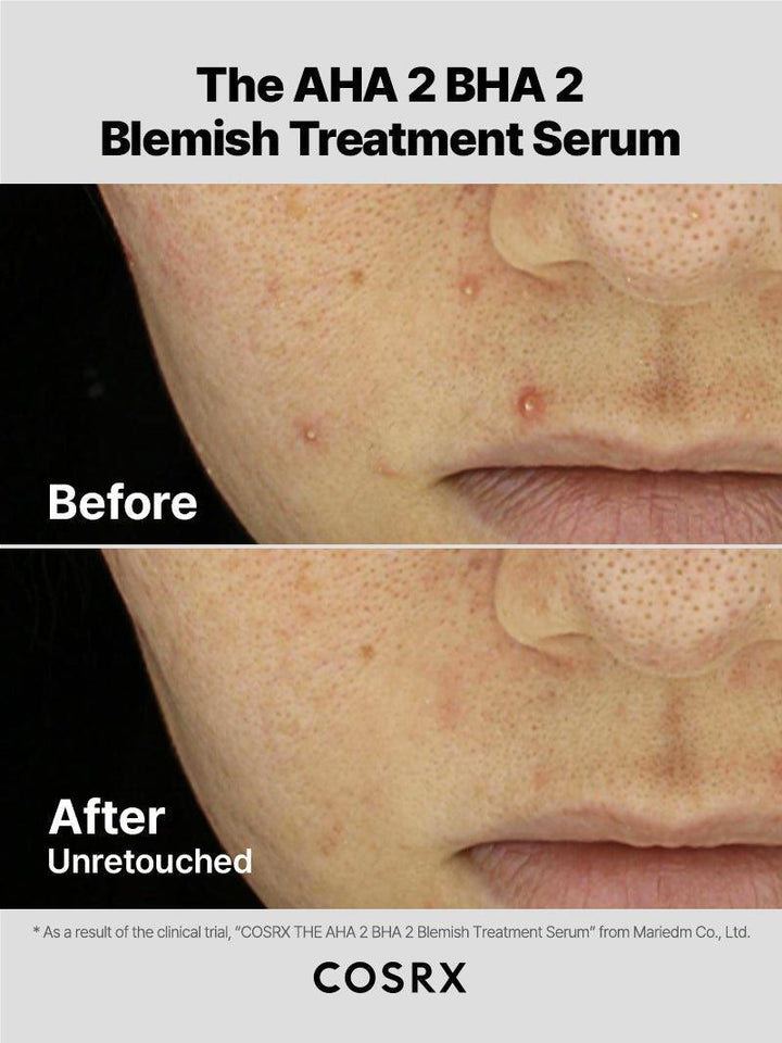 https://cdn.shopify.com/s/files/1/0513/3775/6828/files/AHA2BHA2_Blemish_03__2.jpg?v=1741592927
