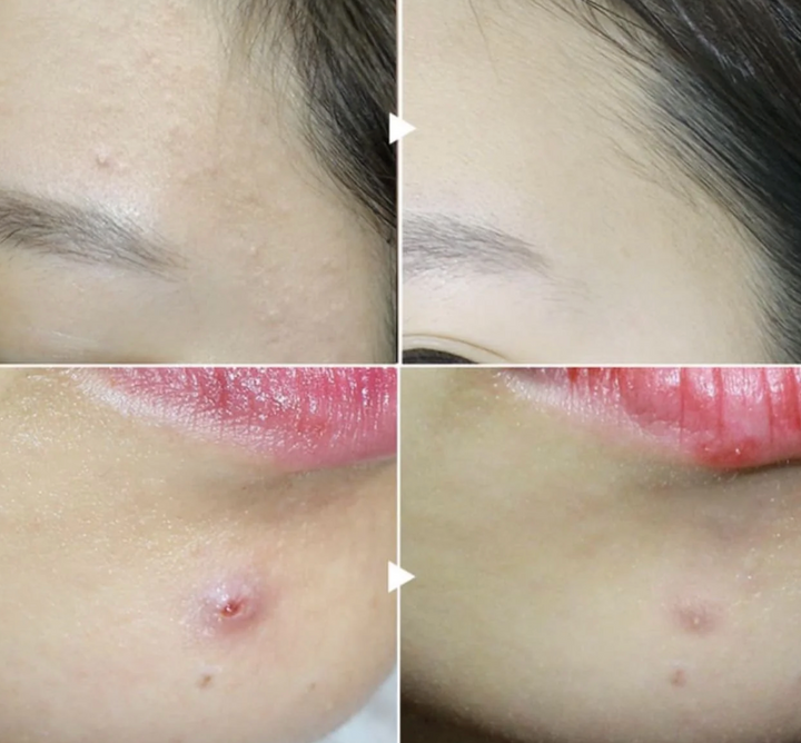 LION - Pair Acne Cream W [24g]