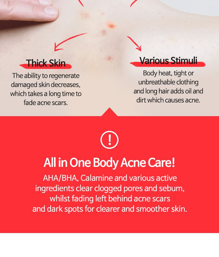 TIA'M Anti-Blemish Body Lotion: Back & Chest Renewal Formula for Clear Skin